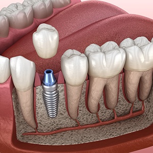 digital illustration after bone graft for dental implants in Louisville 