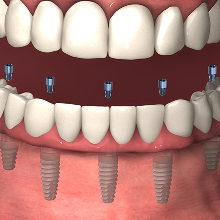 Animated placement of TeethXpress denture