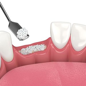 Illustration showing dental bone grafting procedure