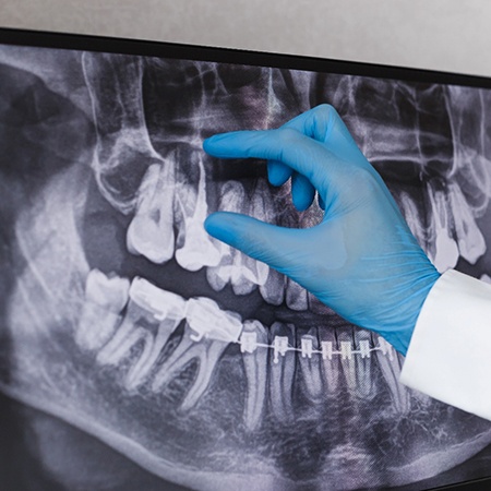 A dentist looking at an X-ray of the mouth
