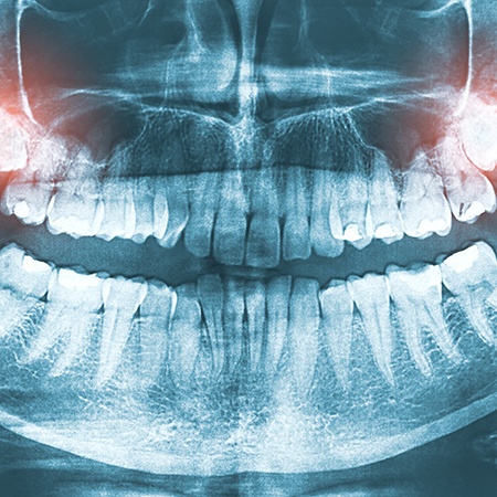 X-ray with two wisdom teeth highlighted in red