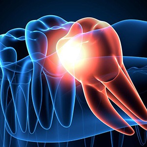 Illustration showing problematic impacted wisdom tooth