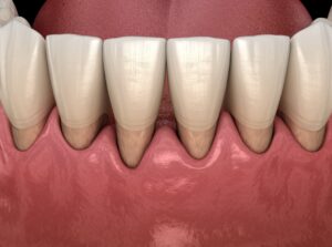 Model of patient’s mouth with advanced gum disease