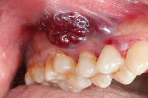 Concerning growth on gums