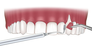 Illustration of gum grafting being performed on upper arch